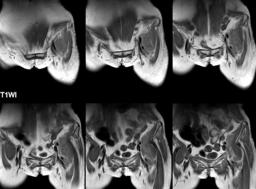 Figure 4 for case Neuritis Ossificans